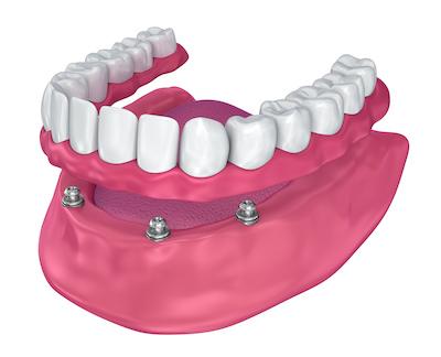 graphic of denture implants in champaign, IL