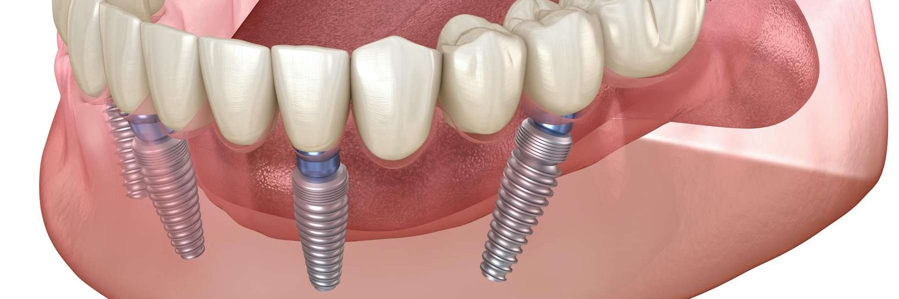 diagram of hybrid dental implants champaign