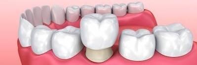 Diagram of same day dental crown in Champaign IL