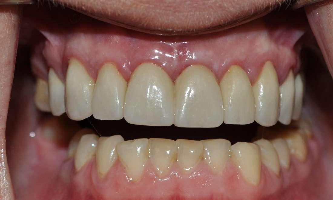 Patients teeth after dental crowns in Champaign, IL