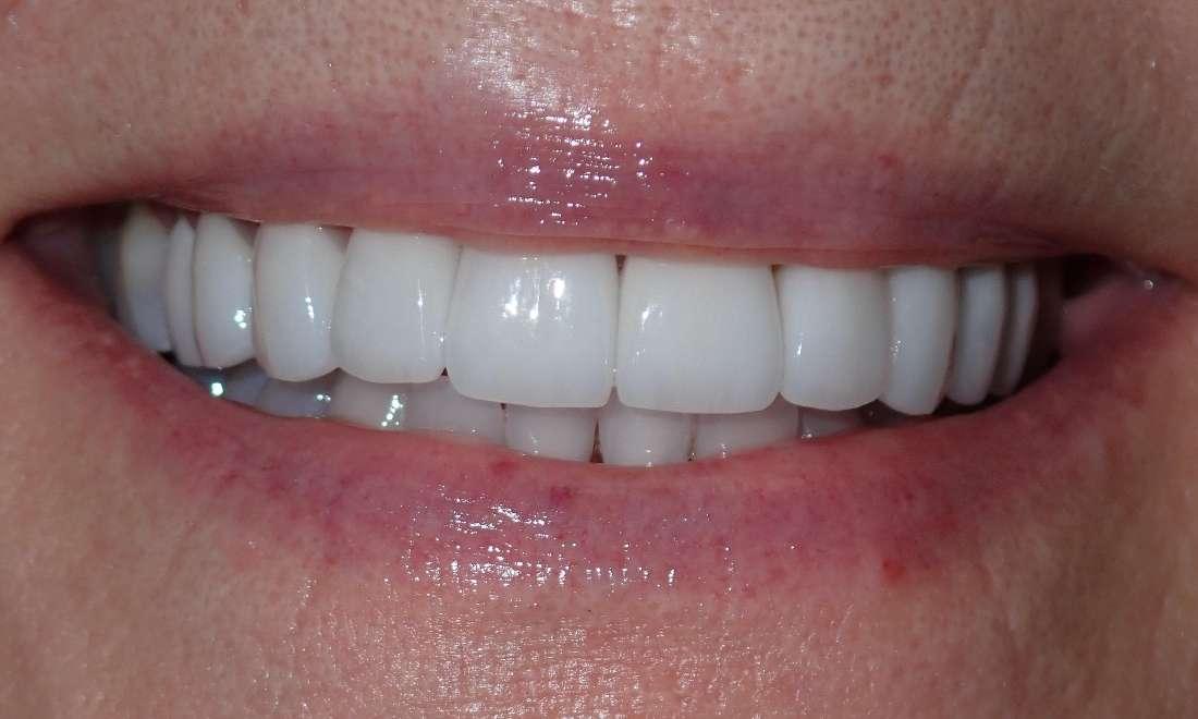 Patient's teeth after veneers and dental implants in Champaign, IL
