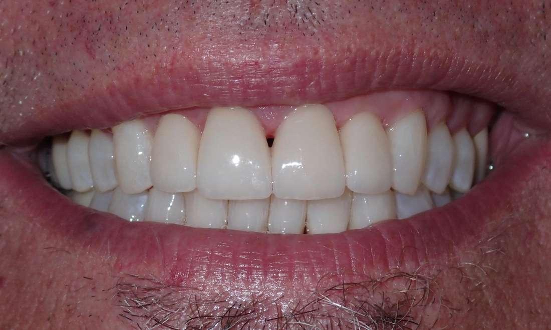 Patient's teeth after ceramic veneers in Champaign, IL