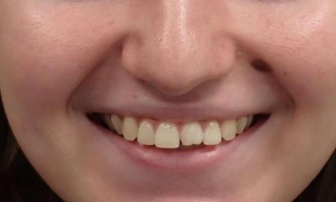 Teeth Repair Smile Gallery