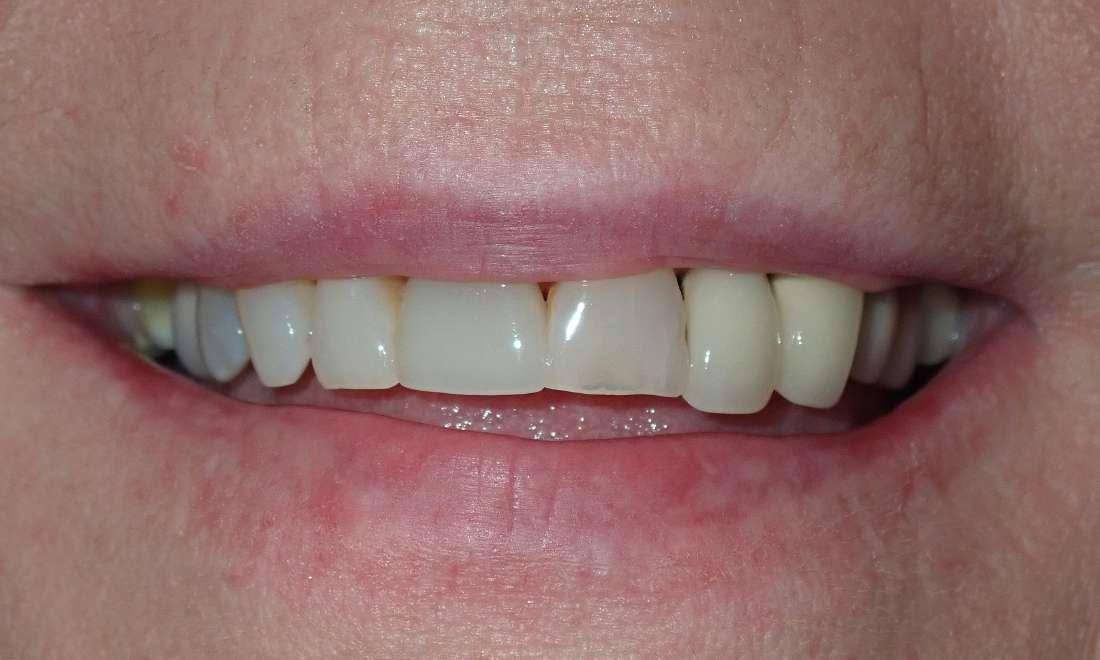 Close up of teeth before dental crowns & implants in Champaign, IL