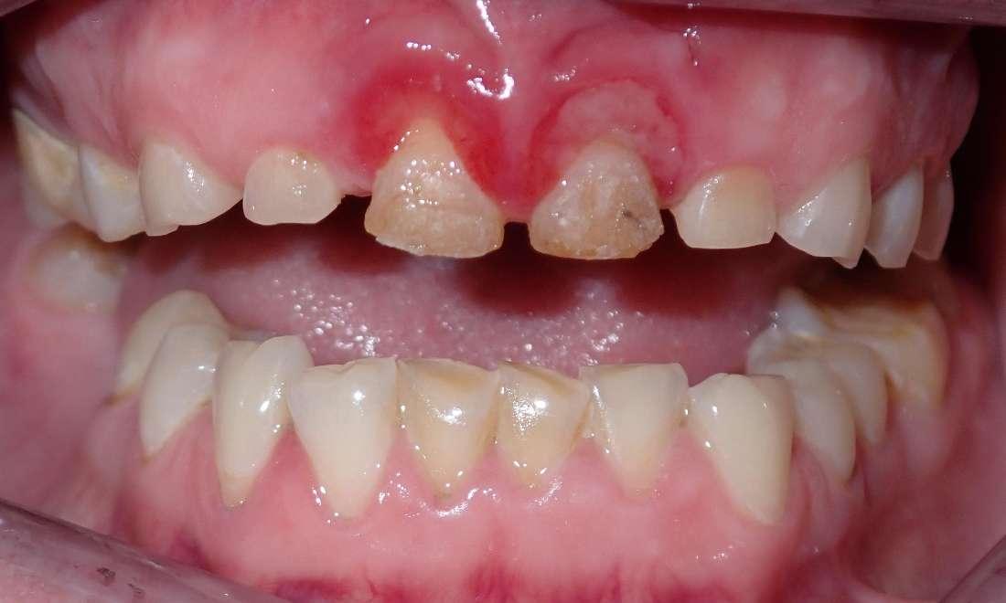 Close up of decayed teeth before dental crowns in Champaign, IL