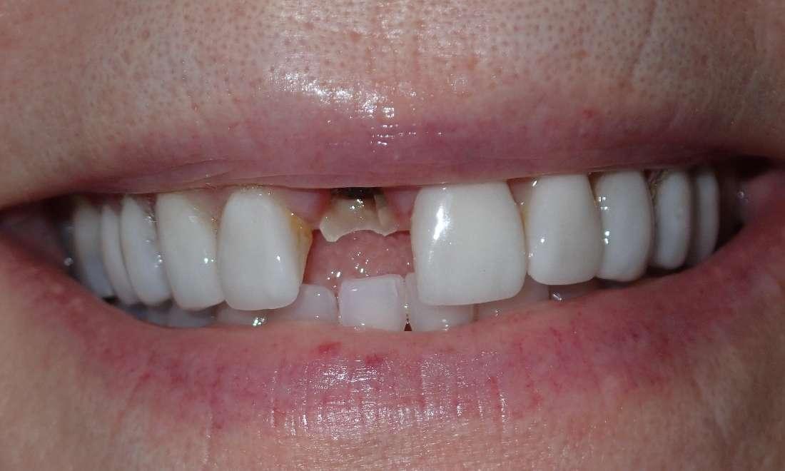Close up of patient with missing front tooth at implant dentist in Champaign