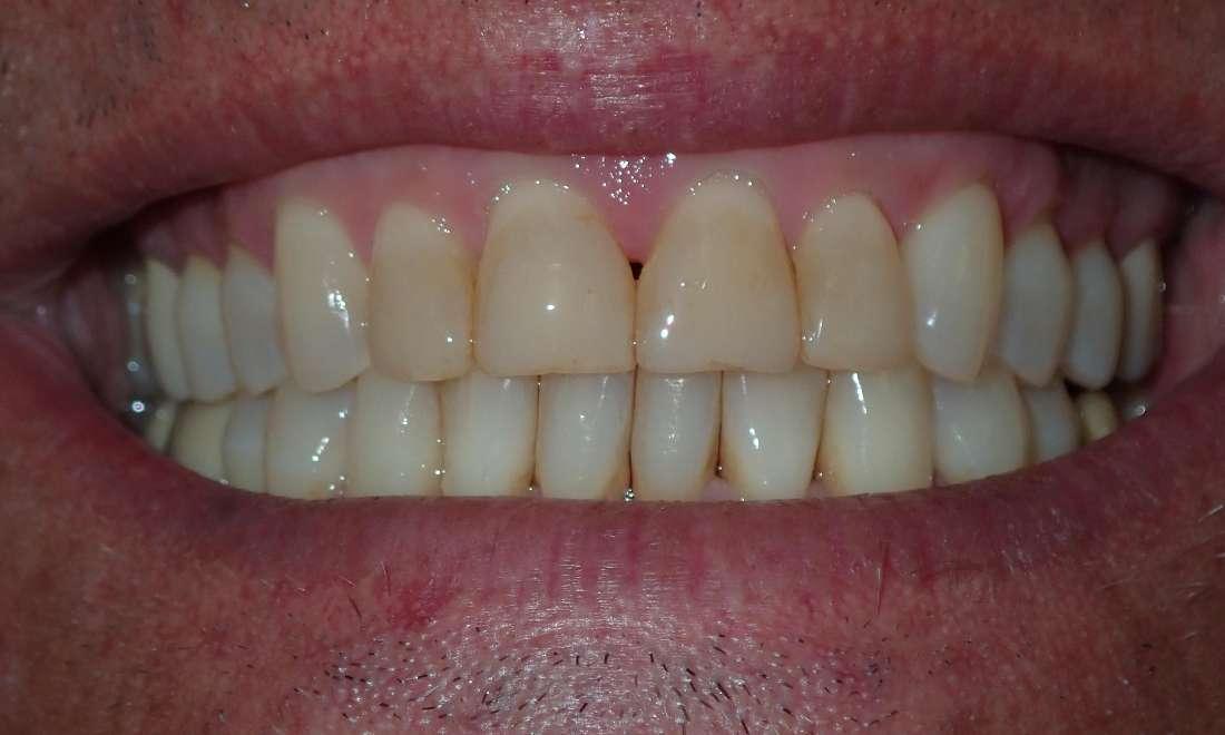 Teeth before ceramic veneers in Champaign, IL