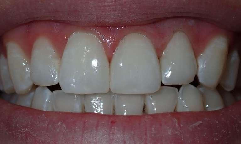 Closed gap in teeth after dental bonding in Champaign, IL