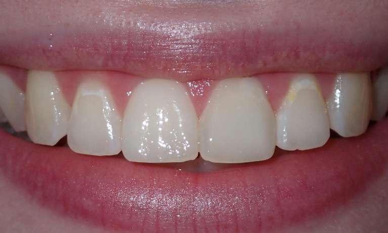 Teeth after dental bonding for broken tooth repair in Champaign, IL