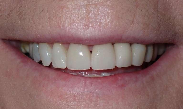 Transformation-with-Ceramic-Crowns-and-Dental-Implants-After-Image