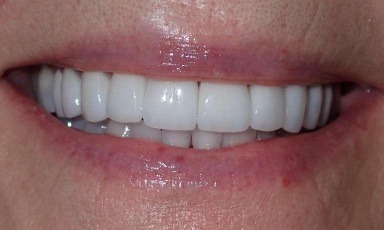 Ceramic-Veneers-and-Dental-Implants-After-Image