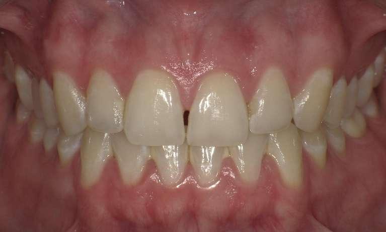 Front teeth with gap before dental bonding in Champaign, IL