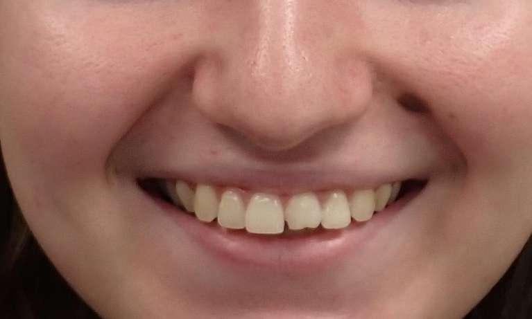 Close up of smile with broken front tooth at emergency dentist Champagin, IL