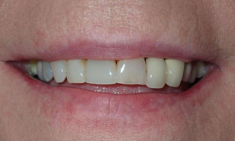 Transformation-with-Ceramic-Crowns-and-Dental-Implants-Before-Image