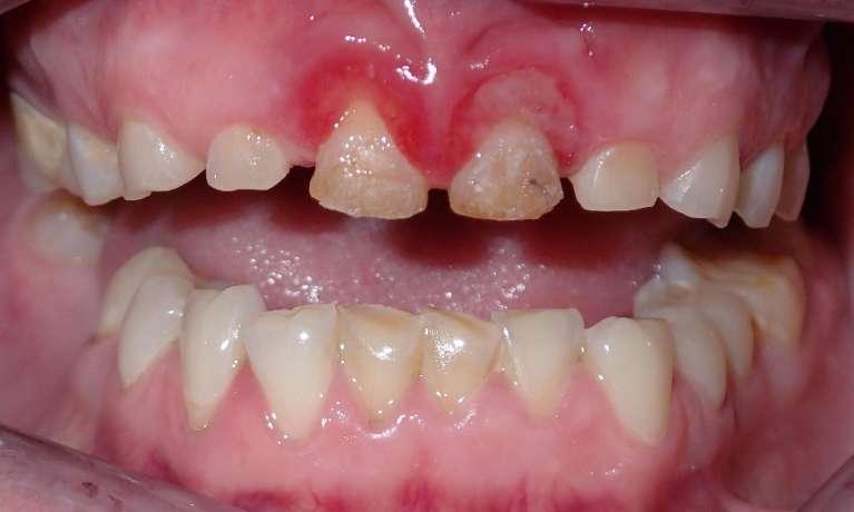 Close up of decayed teeth before dental crowns in Champaign, IL